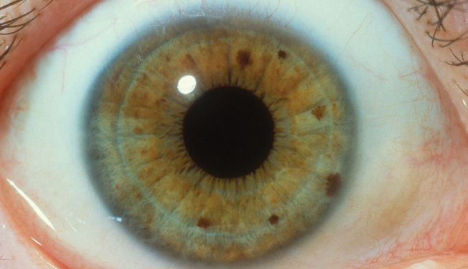 Желтые пятна на радужке глаза. Нейрофиброматоз Реклингхаузена глаза. Нейрофиброматоз на радужке глаза. Анизокория нейрофиброматоз.